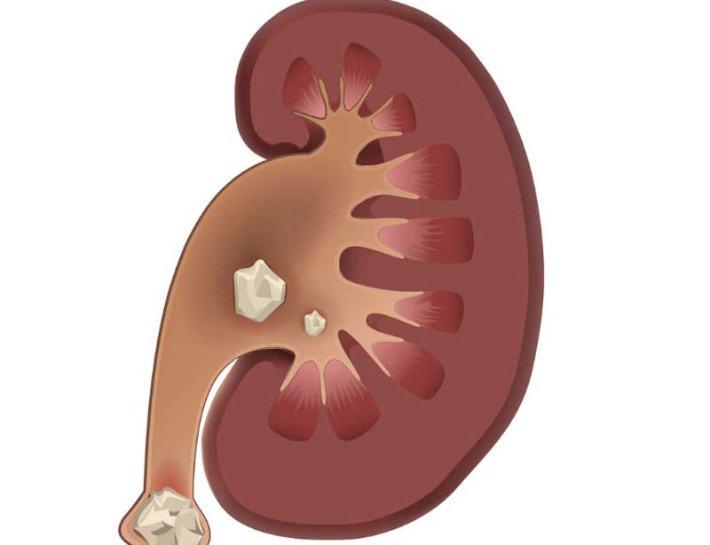 Percutaneous-Nephrolithotomy-UCI-Kidney-Stone-Center