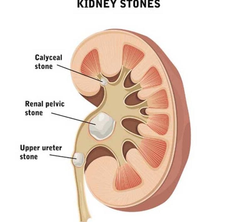 Percutaneous Nephrolithotomy (PCNL) UCI Urology Kidney Stone Center