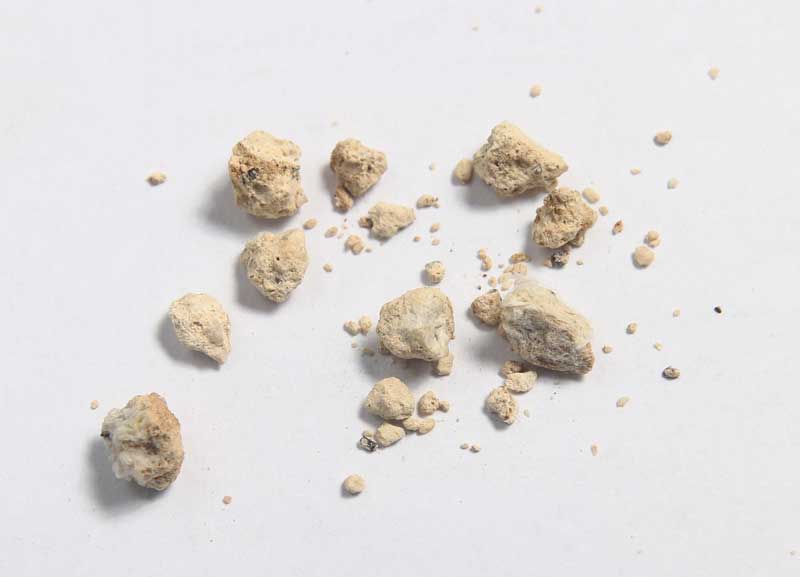 About-Kidney-Stones-UCI-Kidney-Stone-Center