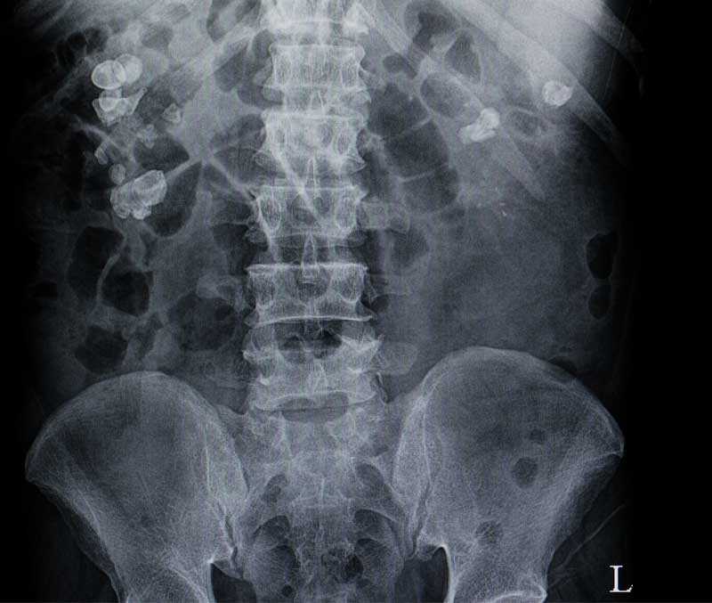 About-Kidney-Stones-UCI-Kidney-Stone-Center