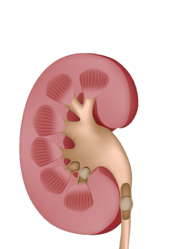 kidney-stones-UCI-Kidney-Stone-Center - kidney stone doctor - Orange County, CA