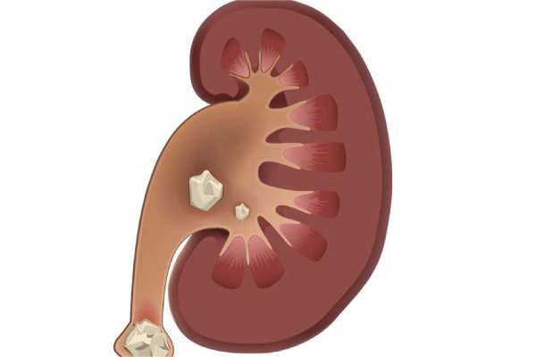 Percutaneous Nephrolithotomy (PCNL) - UCI Kidney Stone Center